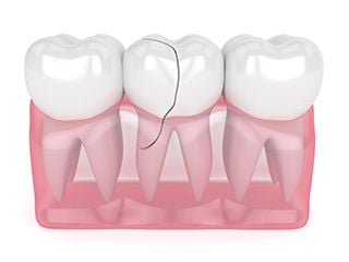 Broken Teeth 1