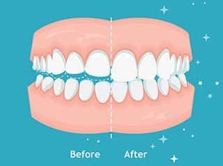 Bruxism 1