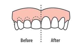 Crown Lengthening 1