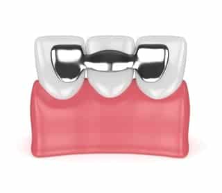 Dental Bridges 3