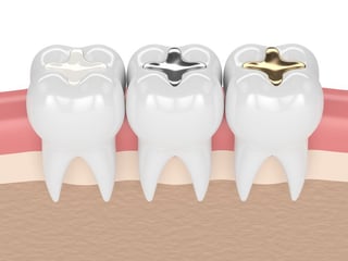 Fillings 1