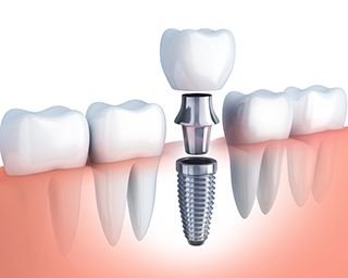 Implant Dentistry 1