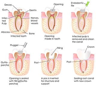 Root Canal Treatment 1