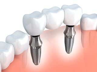 Single or Multiple Dental Implants 1