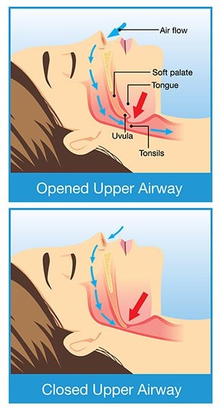Snoring and Sleep Apnea 1