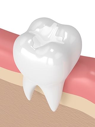 Tooth Colored Fillings 1