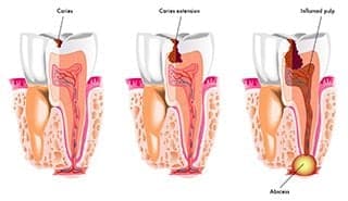Tooth Decay Prevention 1