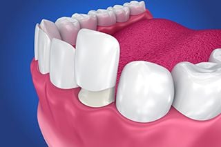 Veneers 1
