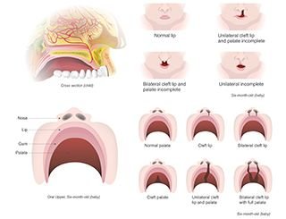 Cleft Lip and Palate 1