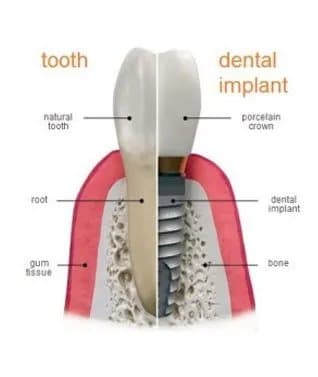 Dental Implants 1 Dental Implants 1
