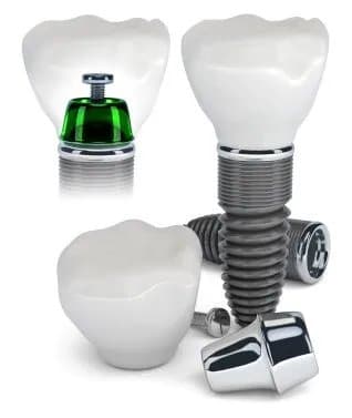 Dental Implants 2 Dental Implants 2