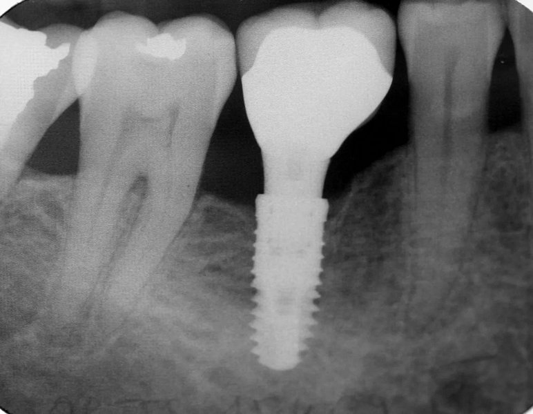 Dental Implants 3 Dental Implants 3
