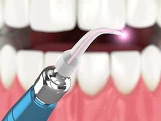 Laser Dentistry 1