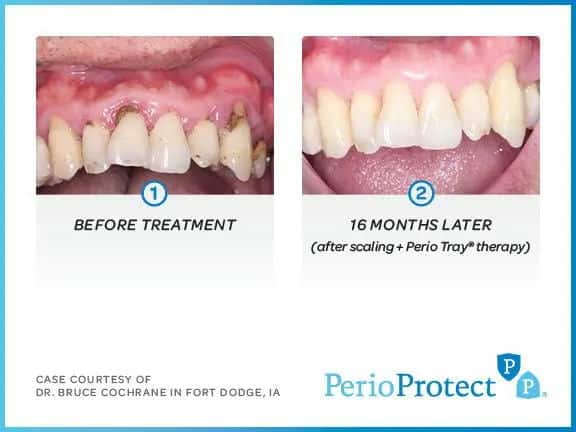 Perio Protect 2 Perio Protect 2