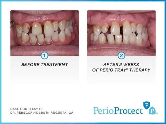 Perio Protect 4 Perio Protect 4