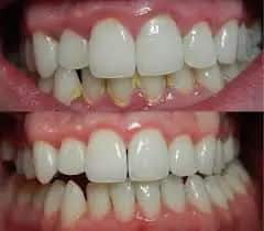 Periodontal gum disease 1