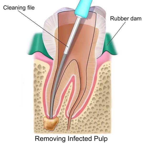 Root Canals 1