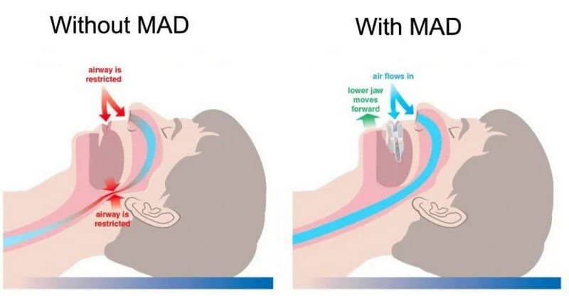 Snoring and Sleep Apnea 4