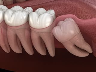 Wisdom Teeth Removal 1