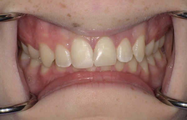 A.A. After