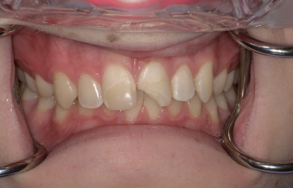 Before A.A. Before