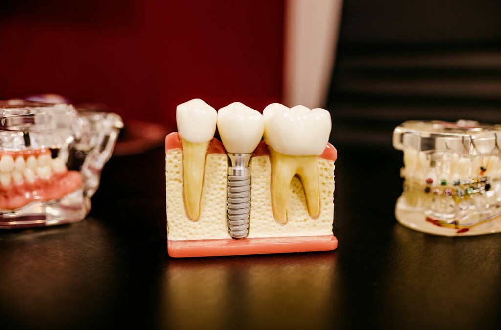 Dental Implants in Bee Caves: What Patients Need to Know