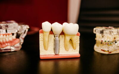 Dental Implants in Bee Caves: What Patients Need to Know