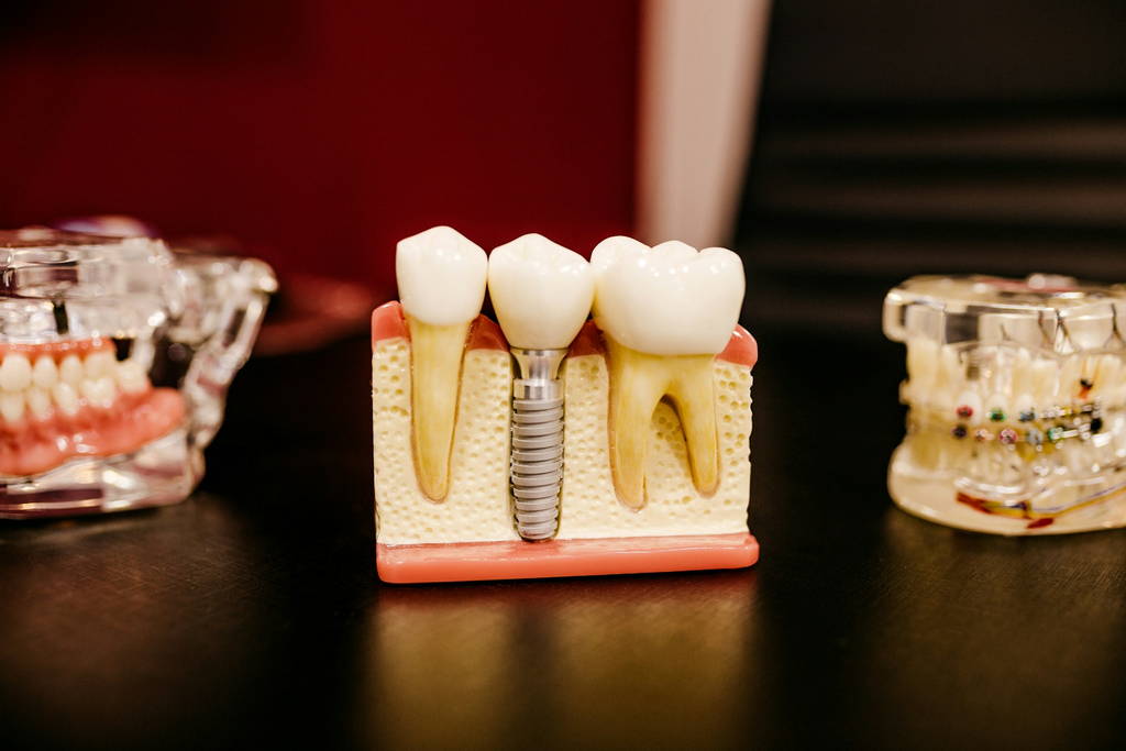 Dental Implants in Bee Caves 2 Dental Implants in Bee Caves