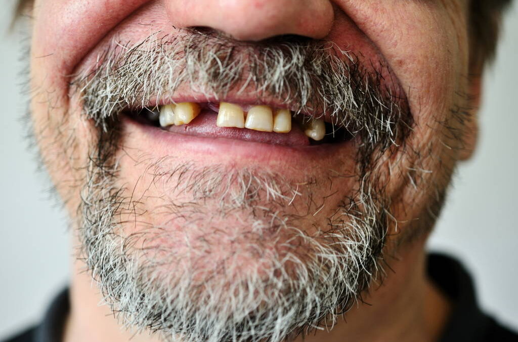 Missing Teeth? Dental Implant Options in Spicewood