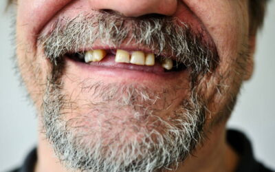 Missing Teeth? Dental Implant Options in Spicewood