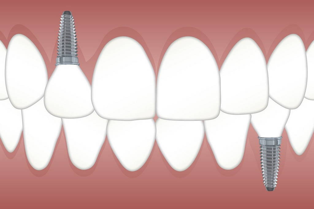 Missing Teeth Dental Implant Options in Spicewood 3
