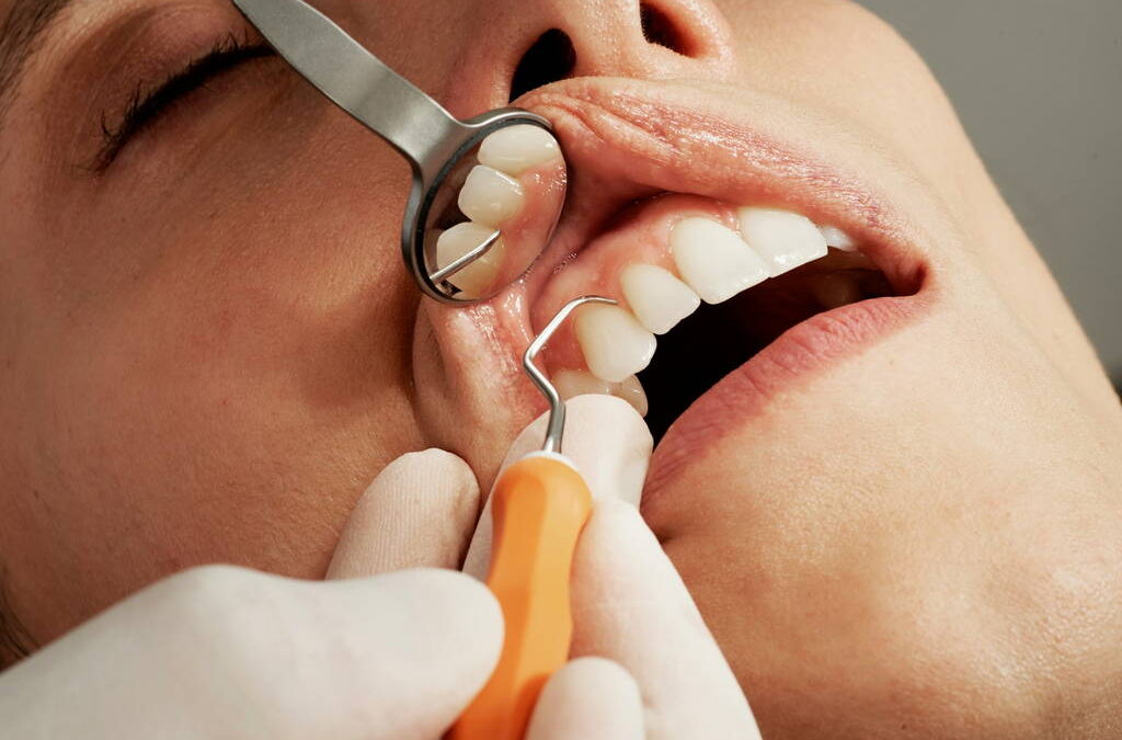 Smile Makeovers with Dental Veneers or Crowns in Spicewood