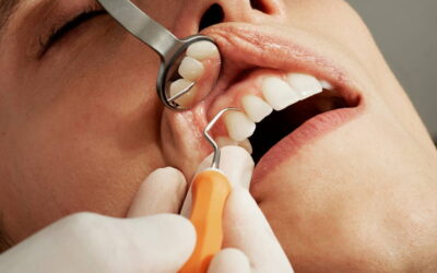 Smile Makeovers with Dental Veneers or Crowns in Spicewood