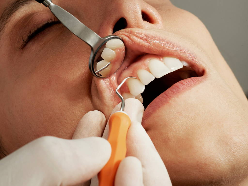Dental Veneers & Crowns in Spicewood 1
