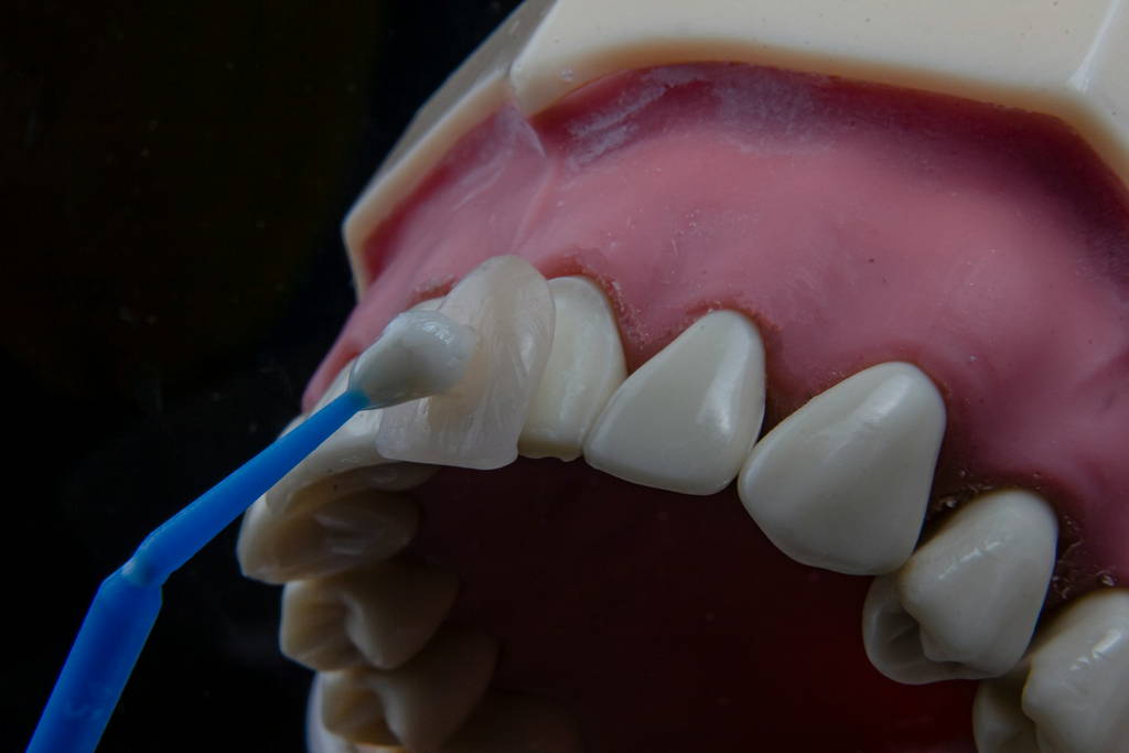 Dental Veneers Crowns in Spicewood 3