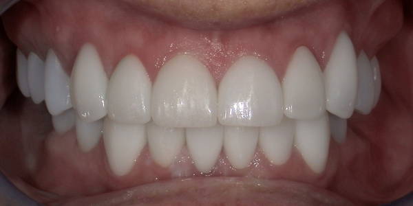Crowns 1 After
