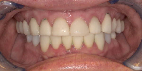 Crowns 1 Before