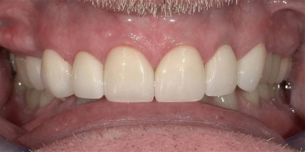 Crowns 2 After