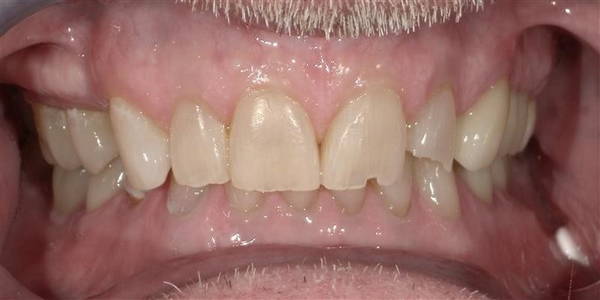 Crowns 2 Before