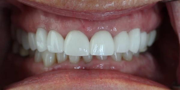 Crowns 3 After