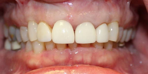 Crowns 3 Before