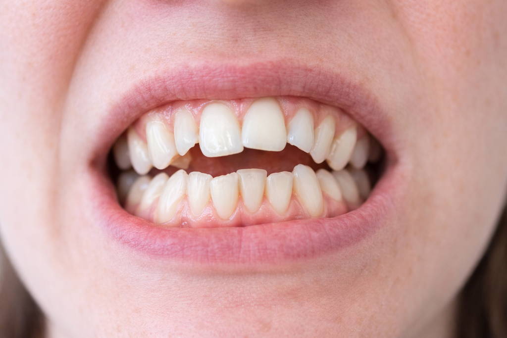 Straighten Your Smile with Clear Aligners in Bee Caves 2