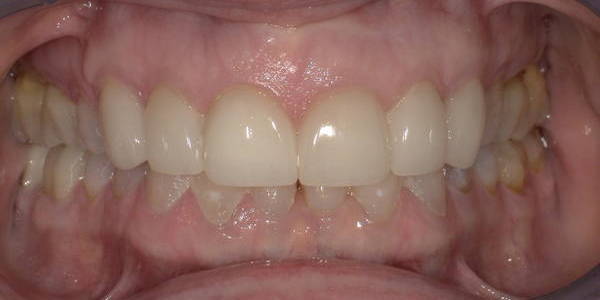 Veneers 1 After 1