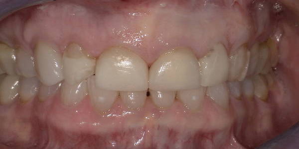 Before Veneers 1 Before 1