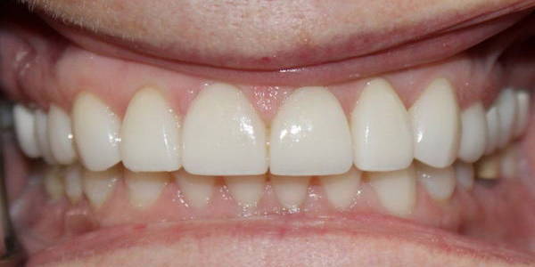 Veneers 2 After 1