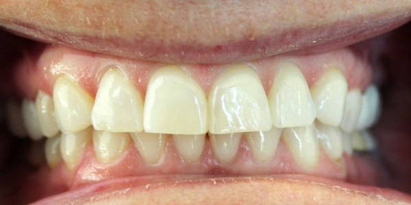 Before Veneers 2 Before 1
