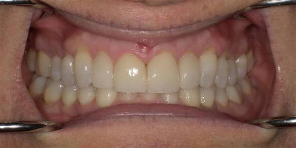 Veneers 3 After 1