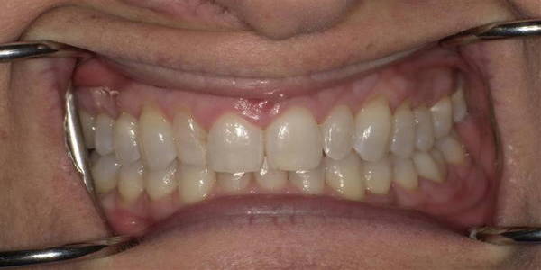Before Veneers 3 Before 1