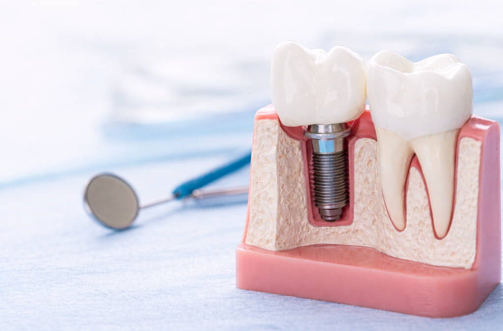 Signs You May Need Dental Implants: Advice from a Spicewood Dentist