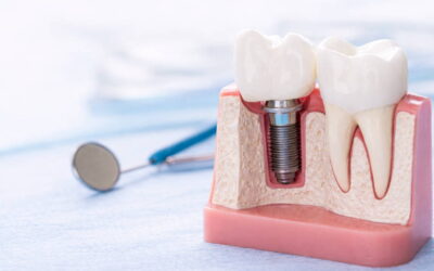 Signs You May Need Dental Implants: Advice from a Spicewood Dentist